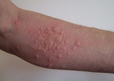 Réaction allergique aux chenilles processionnaires